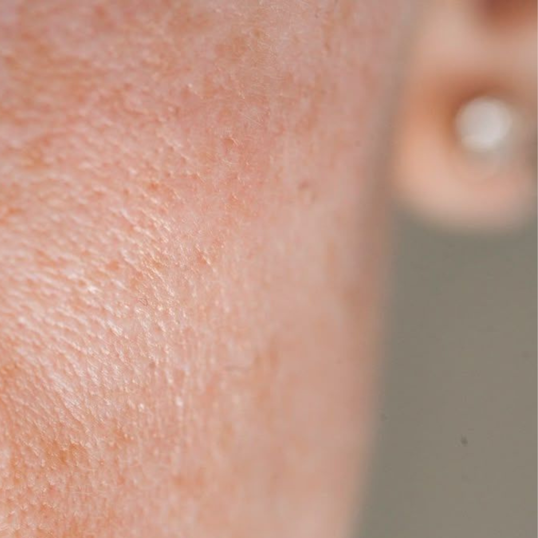 AGEING – SMASH SKIN